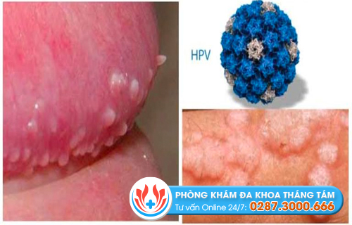 Dấu hiệu nhiễm HPV ở nam giới