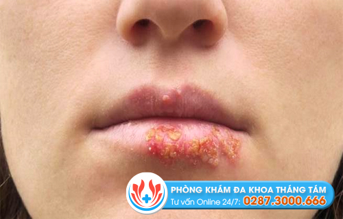Virus herpes ở môi